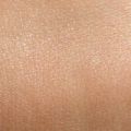 Normal Skin
